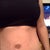 3 weeks post op
