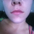 Over a month afterwards - Crooked smile, looks like its deflated on one side - not happy at all.