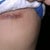 Scar. Very small