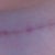 My longer scar is very long and still quite pink/red. Colour is darker in real life, this photo doesn't do it justice.