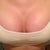 11 days post op
