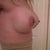 one month post op....side profile of boobs