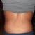 back view 5 days post tt