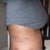 right side view 5days post tt, bruising from the liposuction