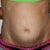 2 weeks before surgery