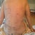 My back is obviously pretty beaten up.....a lot of lipo....so swollen and bruised.