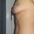 Side view of L breast, my bigger one :-)!! March 15th - 15 hours after surgery.