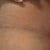 TT Scar 3 months