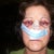 1st day after surgery