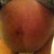 Pre-lipo Front