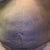 Post-lipo Front (1 day past lipo)