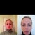 Front profile before and 3wks after