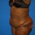 before tummy tuck surgery