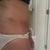 Day 40 - Healing going well.  I'm 3 weeks into my scar therapy and I like the results.