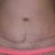 scar after 8 moths posy op