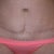 scar after 8 moths posy op