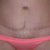 scar after 8 moths posy op