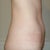 Side view before.