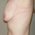 Side view with breasts before. You can really see how low and flat they are.
