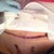 Day of surgery