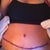 One day post op