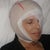 Immediately after surgery. Eye was bandaged (only for a few hours) because one side of face was swollen and eye wouldn't close.