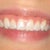This is my smile before invisalign.