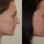 1 month post op