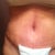 11 days post op.
