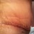 Close up of incision 11 days post op.  The shiny stuff is the Kelo-cote scar treatment.