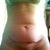Pre-op full frontal.
