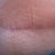 2013 - 9 months post scar revision - 1/1/13 This is the lower middle part of my scar - where I caused tension & stretching - just how I heal I guess!  It was very red a month ago & now it is fading so nicely to a skin color.  I am so pleased!