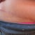 2013 - 9 mo post scar & dog ear revision - You can see the lump of dog ear & also the scar comes 2 inches higher over my swimsuit line.  It does not look so great, but the good part is the scar is fading beautifully & will hardly be noticable one day.  Stinky part is I have to heal another scar there from another dog ear removal.