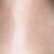 before surgery - view 1