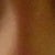 3 weeks after surgery with side lighting - see crater on right eye corner (left in photo)