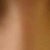 3 weeks after surgery with side lighting, while smiling - see horrible shadow on right eye (left in photo)