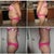 before surgery and 7 weeks after sides