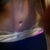 6 day p.o. the scar on my hips are a little higher than id like them to be..the very ending comes out about to how high my belly button is and i do not wear my pants that swooped, mostly straight.