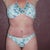 5 Weeks and 4 days post op.  Still swollen on the right hip where I rejected the stitch.  Taken end of day. You can also see the scars from the laser lipo on my breast.