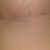 DAY 11: Scar under right breast
