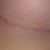 DAY 11: scar under left breast