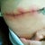 What infected incision looks like.  Hurts worse then the TT!