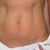Pre-op