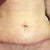 Post op day 20