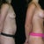Finally here are before and afters! I am now 6months post op.