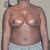 3wks 4days post op