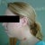 neck after 7 days (major bruise and still swollen)