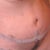 day 11 alil swollen still but theres a close up lol