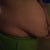 3 months pre-op, before weight loss. Weight 174