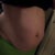 3 months pre-op, before weight loss. Weight 174